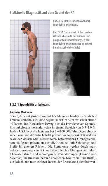 Rheumatoide Arthritis – ein Handbuch - Phadia