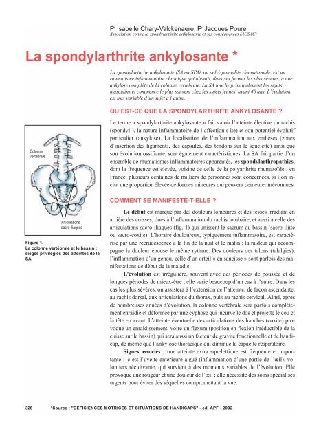 La spondylarthrite ankylosante - Moteurline - APF