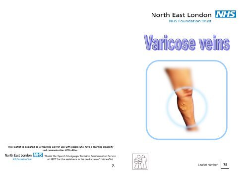 Varicose veins