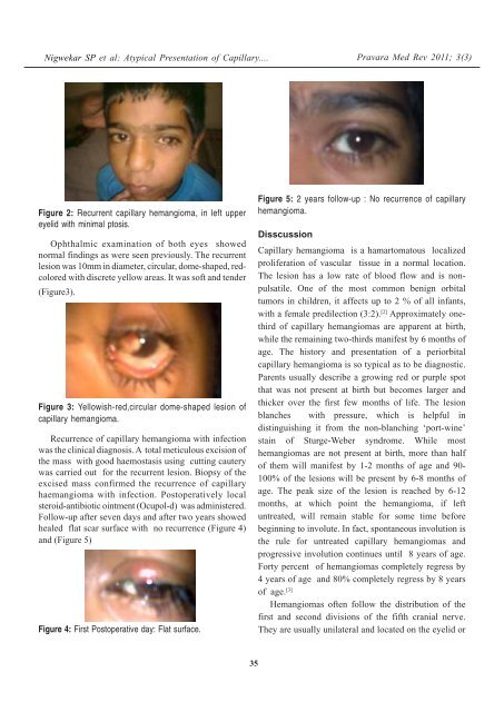 Atypical presentation of capillary hemangioma of upper eyelid