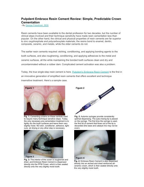 Pulpdent Embrace Resin Cement Review: Simple ... - MM Dental