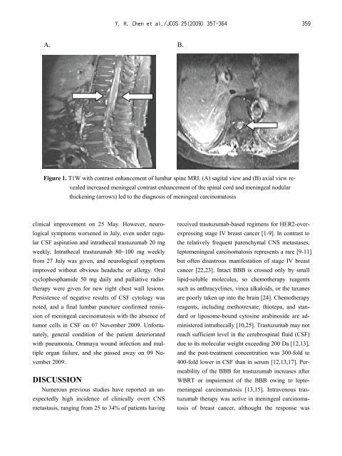 Case Report Intrathecal Trastuzumab for Meningeal Carcinomatosis ...