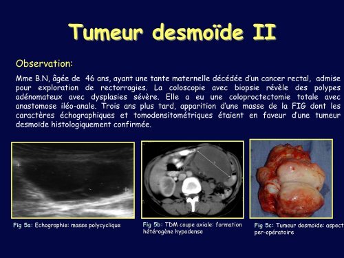 POLYPOSE RECTOCOLIQUE FAMILIALE: COMPLICATIONS ...