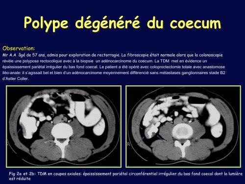 POLYPOSE RECTOCOLIQUE FAMILIALE: COMPLICATIONS ...