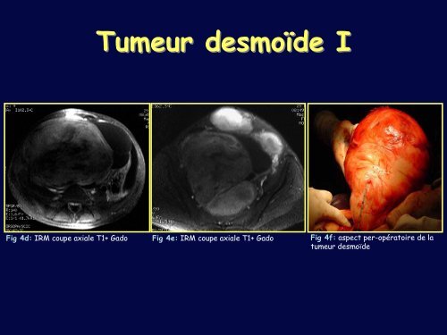 POLYPOSE RECTOCOLIQUE FAMILIALE: COMPLICATIONS ...