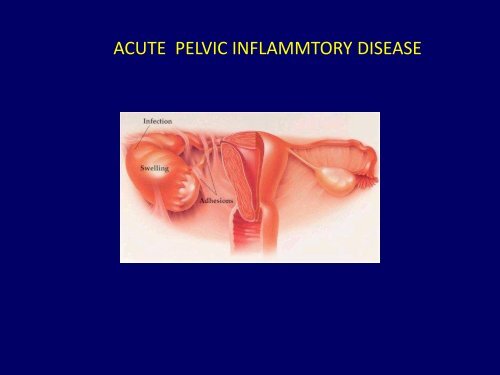 Pelvic Inflammatory Disease (PID)