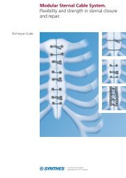 Modular Sternal Cable System - Synthes