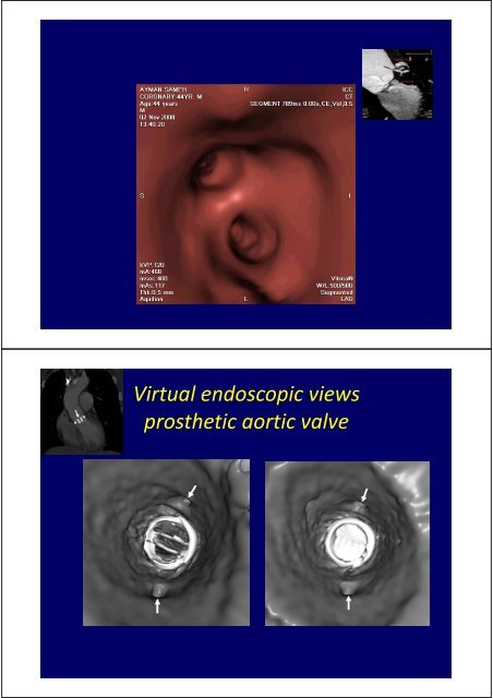 Aortic Dissection