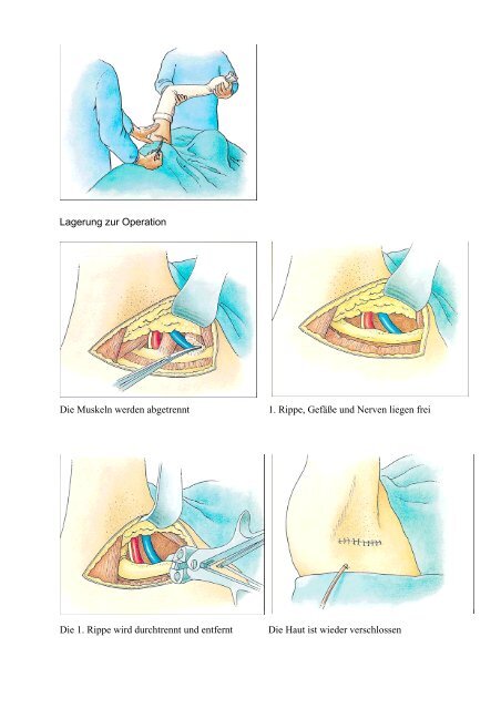 Schultergürtel-Kompressionssyndrom Engpasssyndrome an der ...