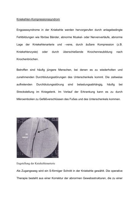 Schultergürtel-Kompressionssyndrom Engpasssyndrome an der ...