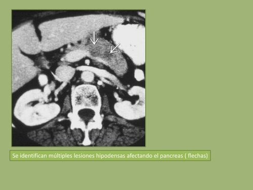 METASTASIS LINFOMA