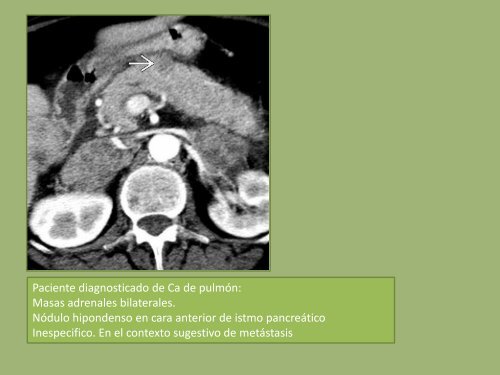 METASTASIS LINFOMA