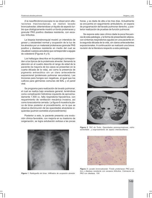 Proteinosis alveolar pulmonar - Asoneumocito