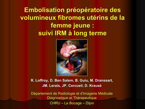 Embolisation prÃ©opÃ©ratoire des volumineux fibromes utÃ©rins de la ...