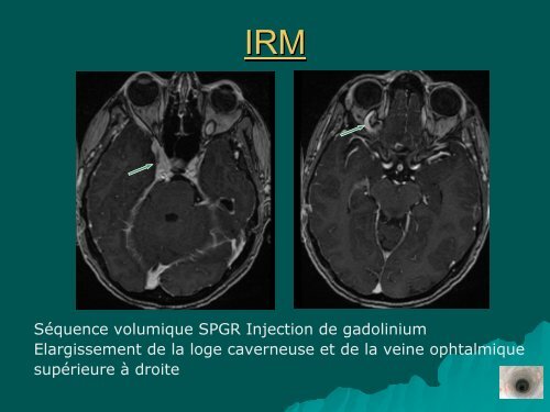 Complications neurovasculaires du syndrome d'Ehlers Danlos type ...