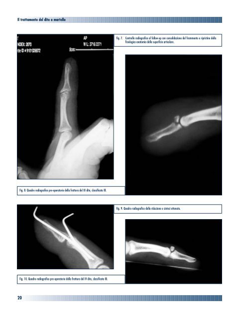 Il trattamento del dito a martello da avulsione osteotendinea alla ...