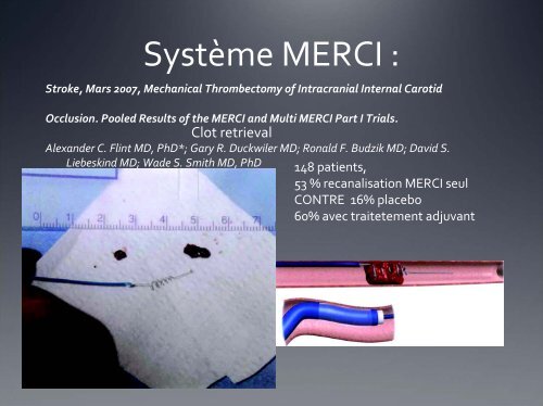 Prise en charge de l'AVC ischémique grave