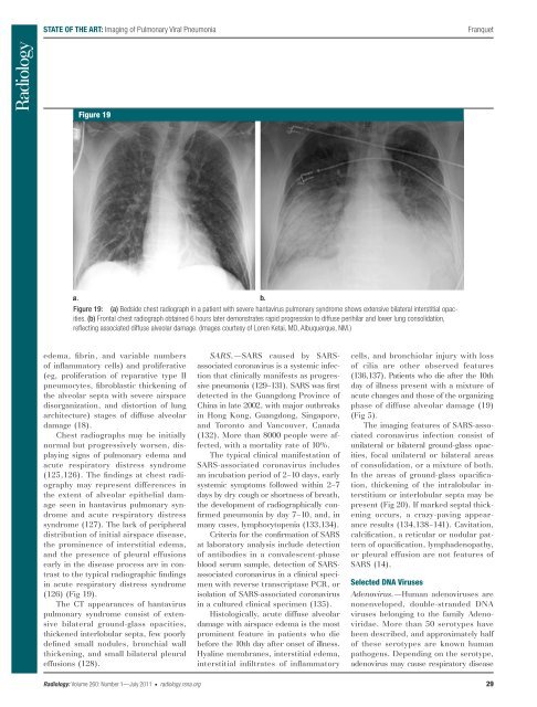 Imaging of Pulmonary Viral Pneumonia 1 - SIRM