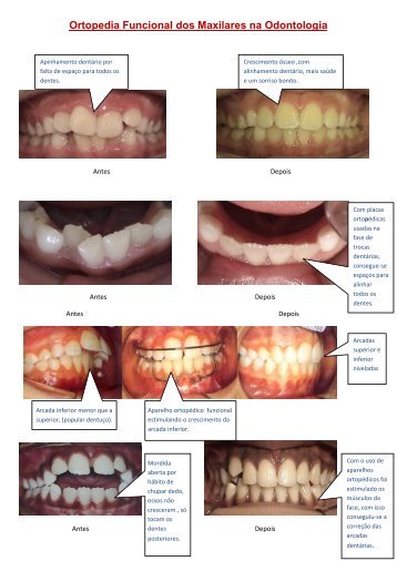 Ortopedia Funcional dos Maxilares na Odontologia