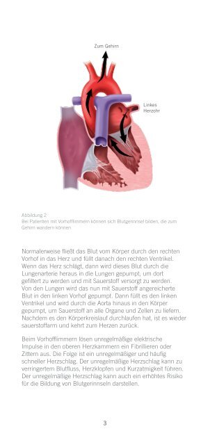 Patientenleitfaden fÃ¼r den Interventionellen ... - St. Jude Medical