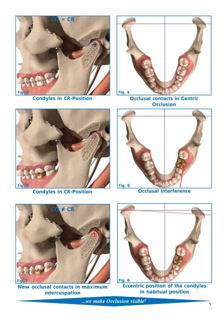 Articulating and Occlusion Test Materials - Janouch Dental