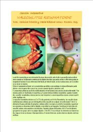 La artritis reumatoidea es una enfermedad de origen desconocido ...