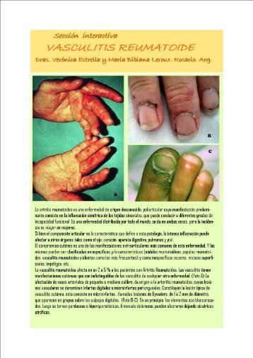 La artritis reumatoidea es una enfermedad de origen desconocido ...