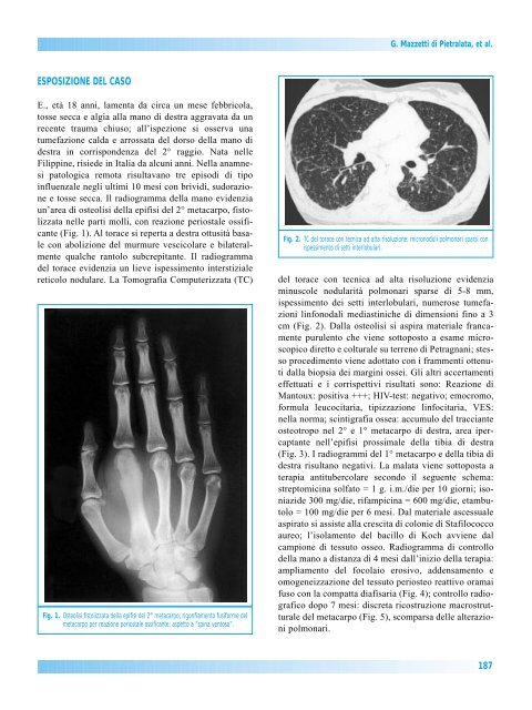 Spina ventosa - Giornale Italiano di Ortopedia e Traumatologia