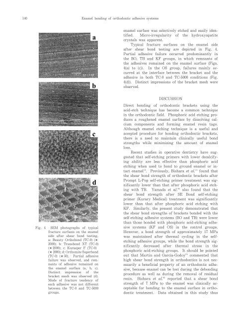 Enamel Bonding of Self-etch and Phosphoric Acid-etch Orthodontic ...