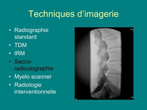 imagerie de la souffrance radiculaire dans les canaux lombaires ...
