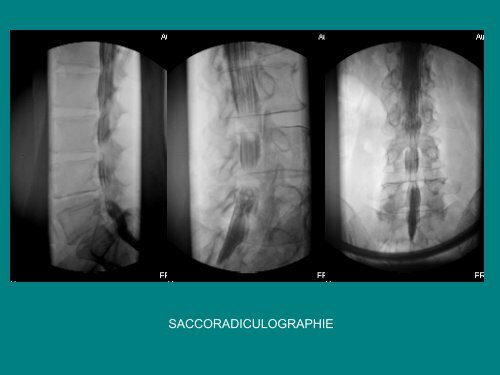imagerie de la souffrance radiculaire dans les canaux lombaires ...