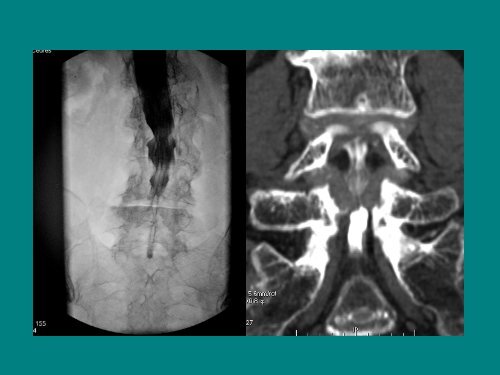 imagerie de la souffrance radiculaire dans les canaux lombaires ...