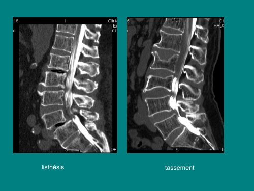 imagerie de la souffrance radiculaire dans les canaux lombaires ...