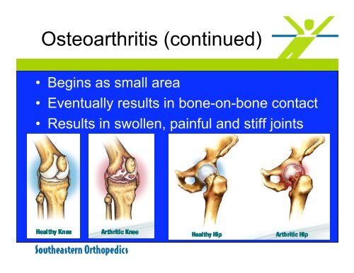 Boomeritis Arthritis of the hip and knee joint - Duke Raleigh Hospital
