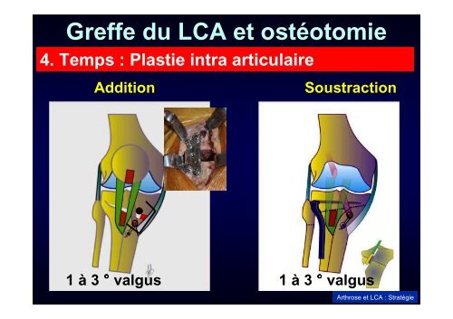 Greffe du LCA et ostéotomie