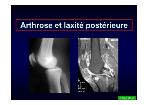 Greffe du LCA et ostéotomie