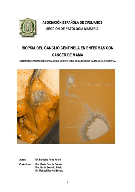 Biopsia del ganglio centinela en enfermas con cÃ¡ncer de mama.