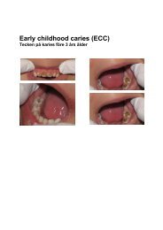 Early childhood caries (ECC)