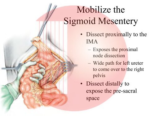 Muscle Invasive Bladder Cancer