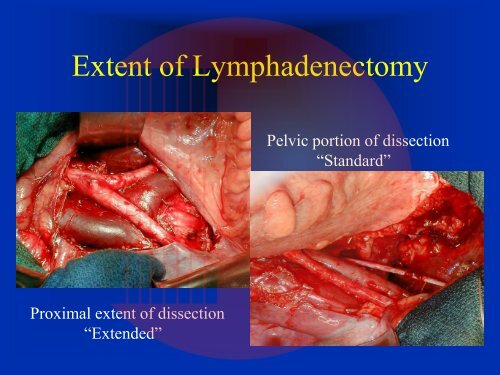 Muscle Invasive Bladder Cancer