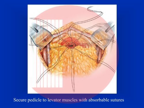 Muscle Invasive Bladder Cancer