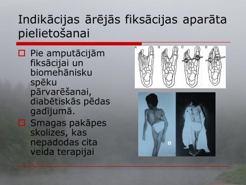 ÄrÄjÄ fiksÄcija ortopÄdijÄ