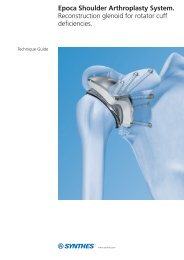 Epoca - Glenoid reconstruction - Synthes