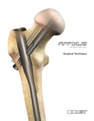 AFFIXUSÃ‚Â® Hip Fracture Nail Surgical Technique - Biomet