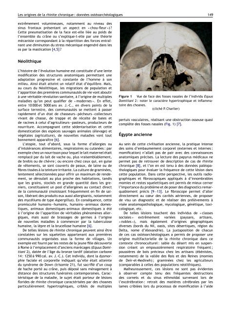 Les origines de la rhinite chronique : donnÃ©es ostÃ©oarchÃ©ologiques