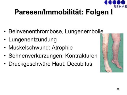 GBS/CIDP: Schmerztherapie - Guillain-Barré Syndrom