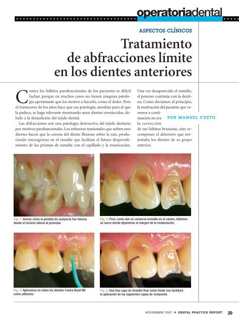 Tratamiento de abfracciones lÃ­mite en los dientes anteriores