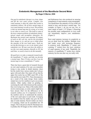 Endodontic Management of the Mandibular Second Molar