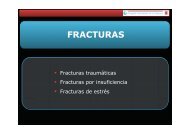 fracturas