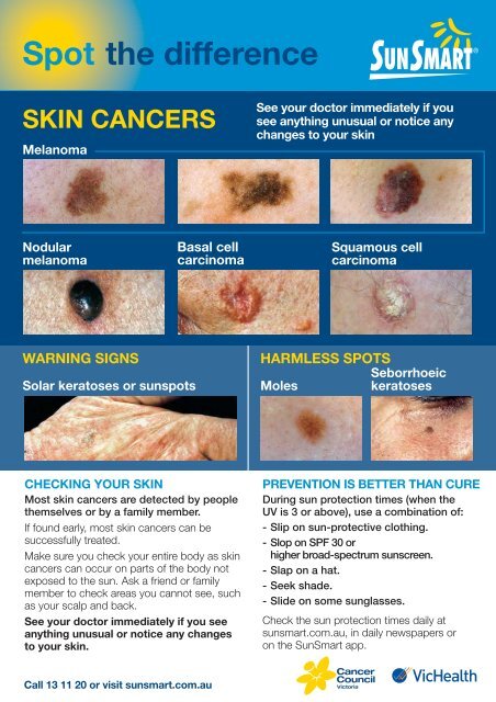 Spot the difference: skin cancers flyer - SunSmart